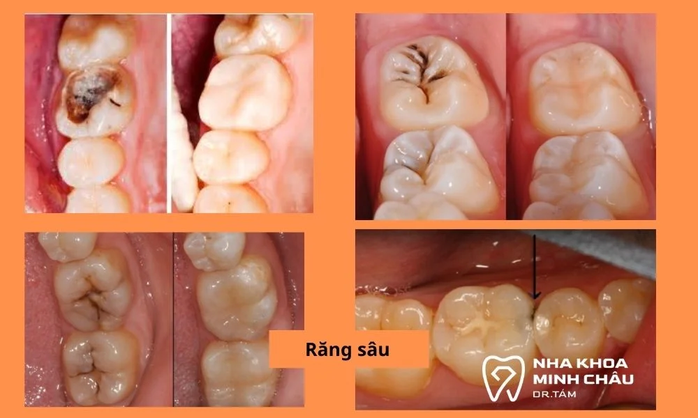 Răng xuất hiện các lỗ sâu