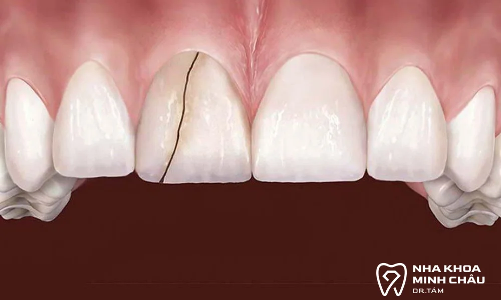 Răng sứ bị nứt, vỡ