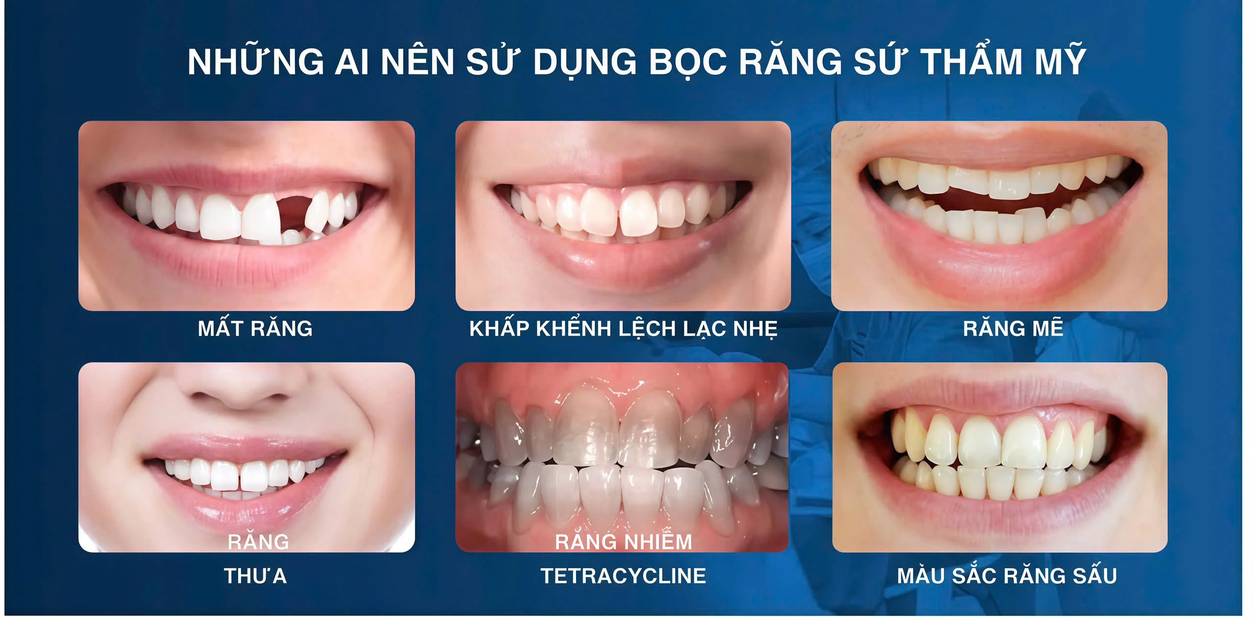 Khi nào nên bọc răng sứ thẩm mỹ?