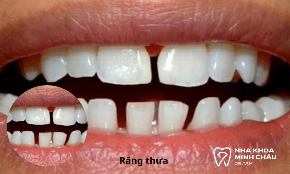 Tình trạng răng thưa