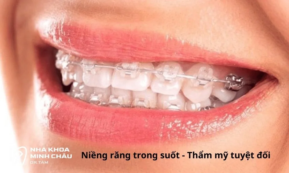 Tính thẩm mỹ cao với niềng răng trong suốt