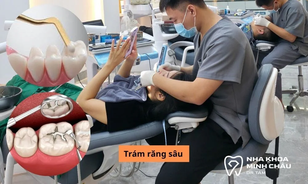 Trám răng sâu