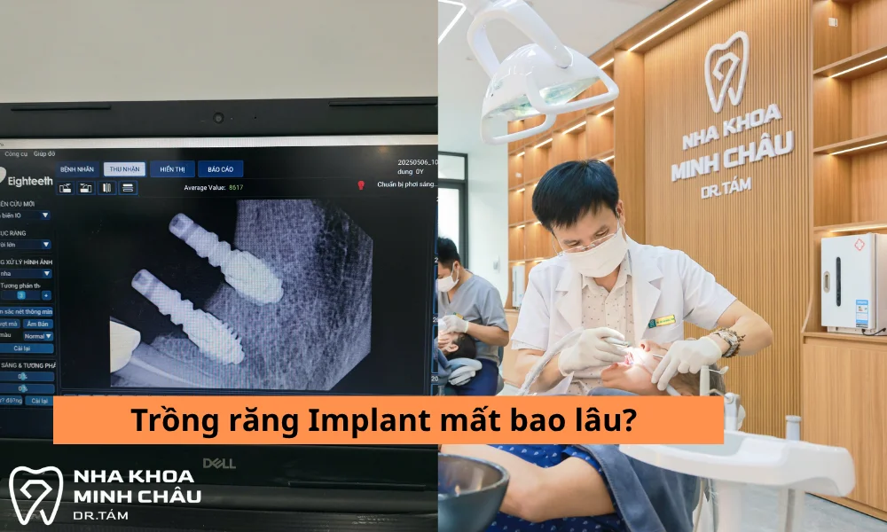 trồng răng Implant mất bao lâu