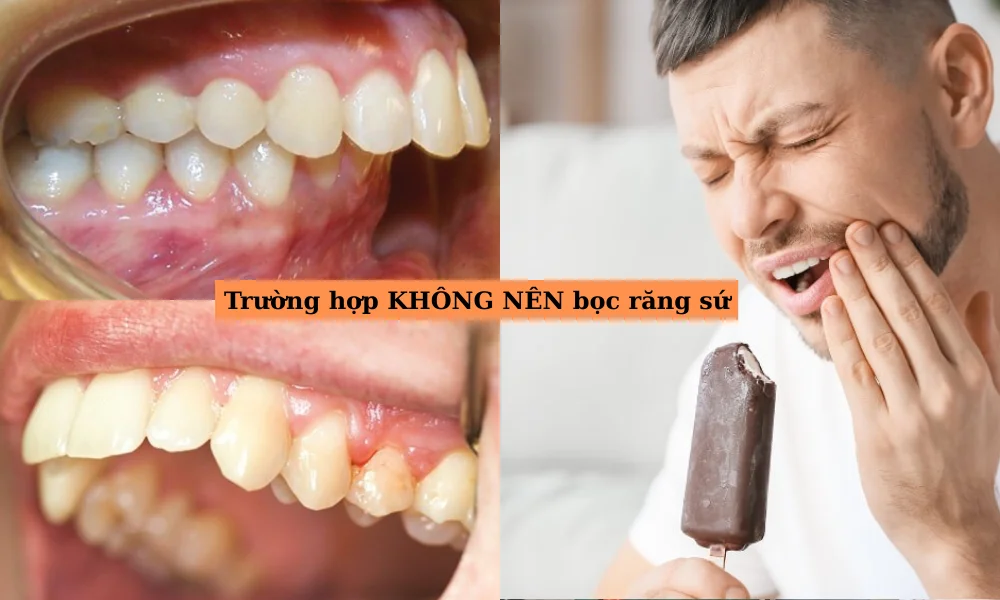 Trường hợp NÊN bọc răng sứ