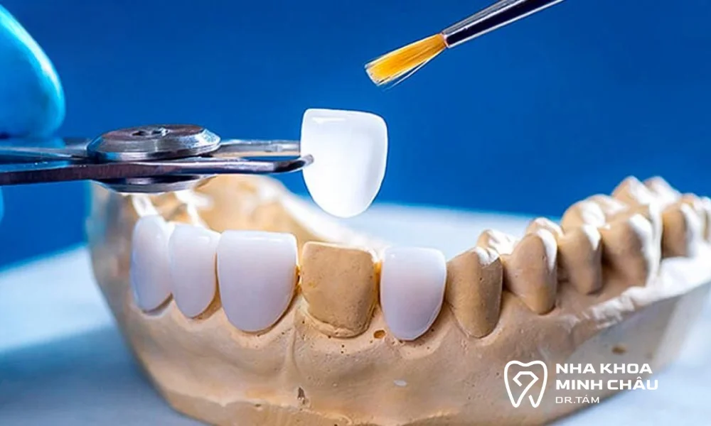 Dán răng sứ Veneer